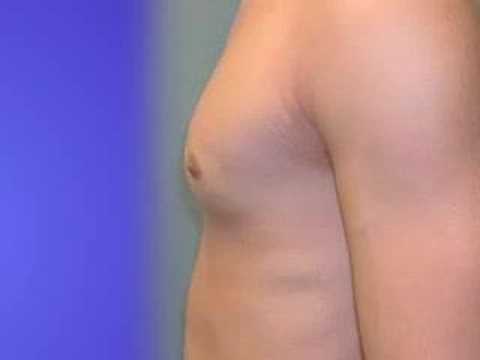 how to know gynecomastia or pseudogynecomastia