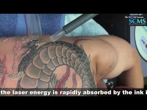 Laser Tattoo Removal