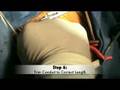 Fontan Procedure with Hybrid Pulmonary Artery Stent - Hypoplastic Left Heart Syndrome (HLHS) - Pediatric Heart Surgery