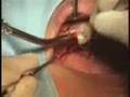 ExFeel Internal Live Surgery - 01