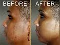 Skin Lightening