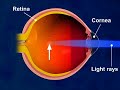 LASIK 3D Medical Animation