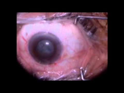 Dr. John Rezapour MD Cataract Surgery, Eye Surgery, Eye Disease, Eye Medications