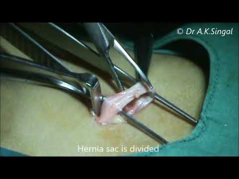 how to assess inguinal hernia