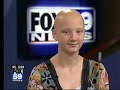 Olivia Rusk discusses Alopecia