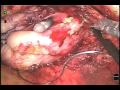 Robotic Simple Prostatectomy