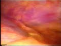Toracoscopia - thoracoscopy - residui di fumo passivo