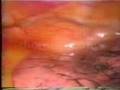 Toracoscopia - thoracoscopy - residui di fumo passivo
