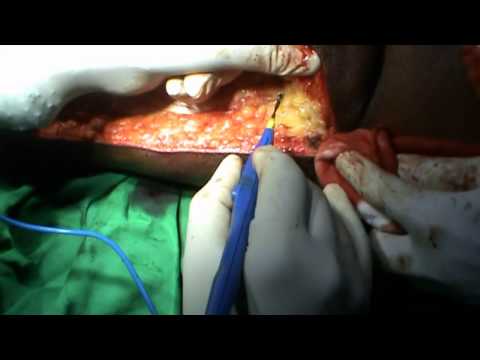 how to harvest tensor fascia lata