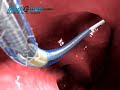 Cardiology heart valve stent 