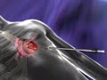 3D medical animation Cardiology heart valve stent