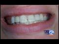 Mini Dental Implants - Denture Stabilization AM Buffalo II Mini Dental Implants - Denture Stabilization AM Buffalo II