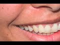 Brighten Teeth in Photoshop!