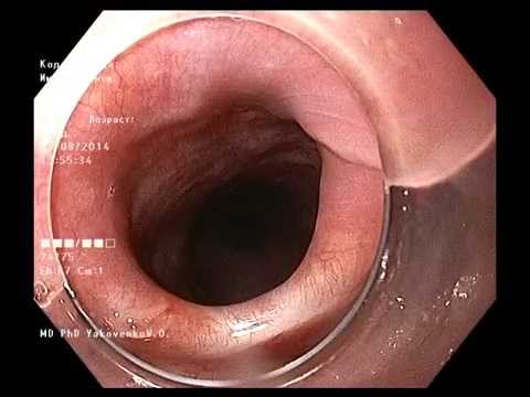 how to treat zenker's diverticulum
