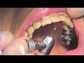 Re-contouring Incisal Edge