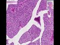 Histopathology Ureter--Transitional cell carcinoma