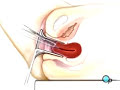 PreOp® Patient Education: Dilation and Curettage D and C pt2