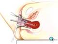 PreOp® Patient Education: Dilation and Curettage D and C pt2
