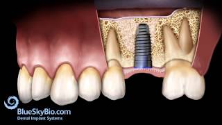 Internal Sinus Lift