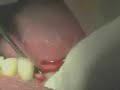 Hand piece punch