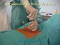 Cifoplastia cirugia