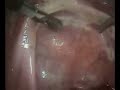 Endometriosis estad�o I