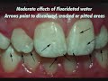 The Truth About Water Fluoridation
