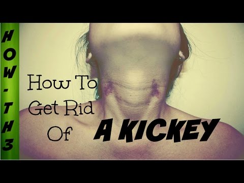 how to remove hickies