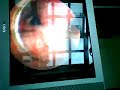 World 1st self optical urethrotomy World 1st self optical urethrotomy