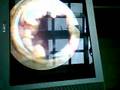 World 1st self optical urethrotomy