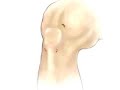 Patient Education: Arthroscopic Meniscus of Knee 2