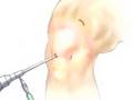 PreOp® Patient Education: Arthroscopic Meniscus of Knee 2