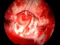 Meningoma - Procedure Of Fascial Patch And Sinus Balloon Meningoma - Procedure Of Fascial Patch And Sinus Balloon