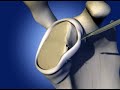 Shoulder Labral Repair
