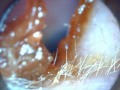 Ear Wax Removal blocking Ipod head phones
