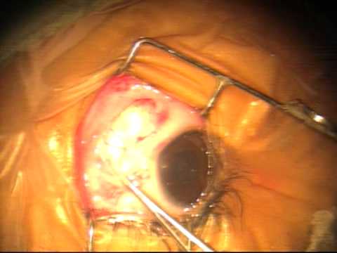 how to cure squint eye without surgery