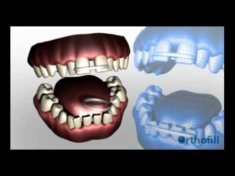 how to fill small gaps in teeth