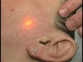 ActiveFX Procedure (Kenkel) ActiveFX Procedure (Kenkel)