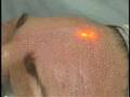 ActiveFX Procedure (Kenkel)