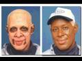 Vitiligo
