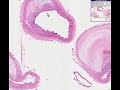 Pathology - Histopathology of coronary atherosclerosis (correct YouTube link)