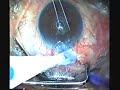 Canoacrylate in managing flat AC after trabeculectomy Canoacrylate in managing flat AC after trabeculectomy