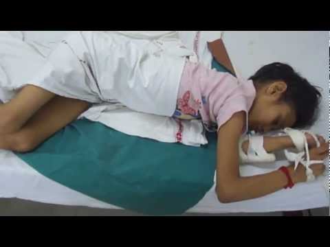 how to treat nmdar encephalitis