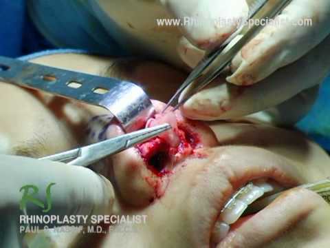 Demonstration of a Shield Graft & Alar Rim Graft Surgery