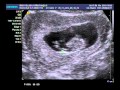 ULTRASSOM COM 11 SEMANAS DE GESTA��O