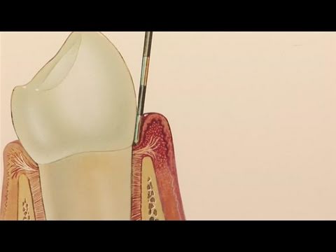 how to relieve gum pain from braces