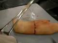 My First Suture