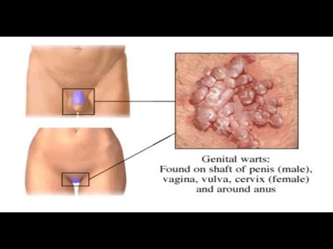 how to get rid genital warts at home