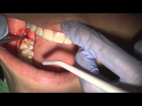 how to relieve impacted wisdom teeth pain