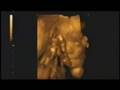 4D Ultrasound